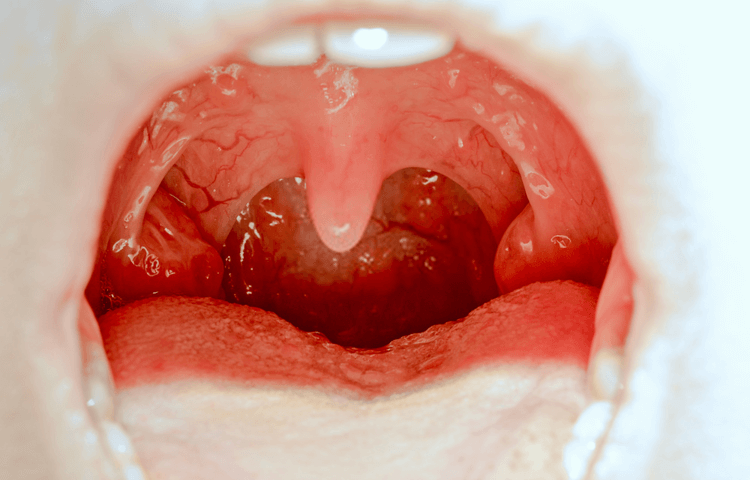 Tonsils - The Brain's Drain